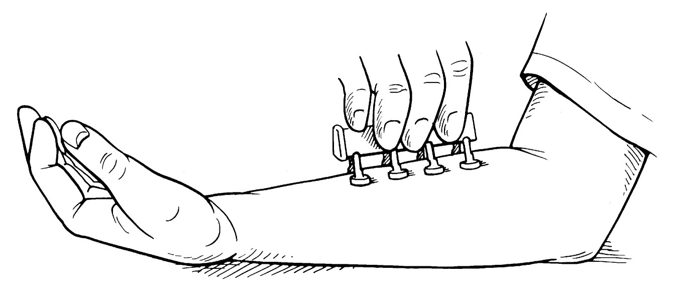 Figure 11-1: A multiple skin test applicator can be  used to administer prick-puncture skin tests.